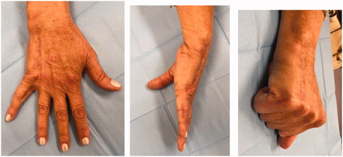 Figure 6. Post-operative views at 22 months showing complete wound healing without functional limitation: dorsal (A), and medial (B,C) views.