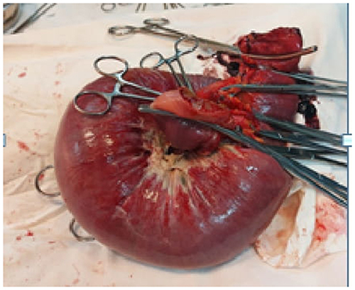 Figure 3 The resected Intussusceptum.