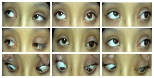 Figure 1 Preoperative presentation of Case 8 with left hypotropia and limited elevation in all gazes and one previous ptosis surgery.