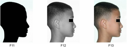 Figure 1 Models of silhouette (F11), black and white photograph (F12), and chromophotograph (F13) of the same boy.