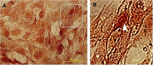 Figure 4 The morphology of adipose-derived stem cells (ADSC) labeled by Super Paramagnetic Iron Oxide Nanoparticles (SPIONs). (A) ADSCs were fixed in 4% paraformaldehyde and then stained using Prussian blue and counterstained with safranin. (B) shows a high magnification of the arrowhead indicates that the ADSC cytoplasm was covered with iron oxide particles.