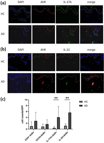 Figure 4 AhR+ CD4+T cells, CD19+ B cells, Th17 cells (a) and Th22 cells (b) in skin lesions of AD and healthy control were shown by Immunofluorescence staining. AhR+ Th17 cells and AhR+ Th22 cells were significantly increased in AD skin lesions (c). a,b×200. Nuclei were counterstained using DAPI. Data are displayed as mean±SEM. **P<0.01.