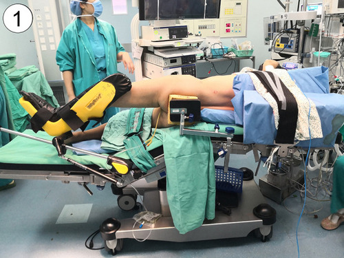Figure 1 Patient position. The patient was placed in standard 90° full flank position and secured to the table, then the table was rotated to maximize exposure of the kidney.