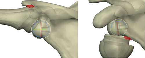 Figure 2 Shows the simulation of impingement in the shoulder joint after RSA during abduction and internal rotation.