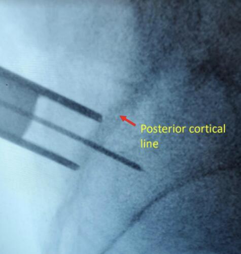 Figure 3 Fluoroscopic image of external dilator at the posterior cortical line in the lateral view.