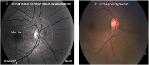 Figure 3. Illustrating assessment of retinal vessel diameter and count in a control eye (Fig 3A); and retinal neurodegenerative risk signs in a stress-phenotype case with ongoing ischemia (S100B ≥0.1μg/L) (Figure 3(B)). The blue V, indicates veins and the red A, indicates arteries.