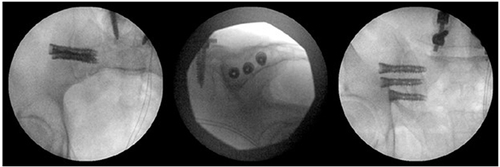 Figure 1 Pelvic inlet, lateral, and outlet intraoperative images.