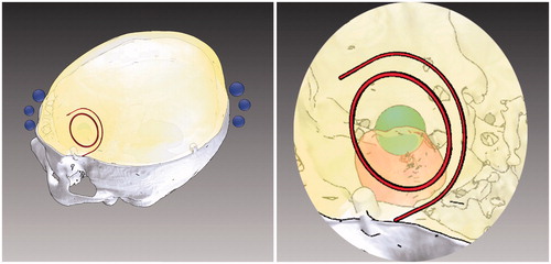 Figure 3. Surgical planning for skin incision and craniotomy. Elaboration of the surgical planning on the three-dimensional rendering of the segmented anatomy, obtained by means of a semi-automatic segmentation software. Left: visualization modalities exploited to depict the planned skin incision and the planned craniotomy. Right: a zoomed detail with enhanced transparency of the surgical planning scene. The size, shape, and location of the craniotomy and of the skin incision were deducted on the basis of the optimal dissection corridor planned for accessing the surgical target whilst avoiding the eloquent area.