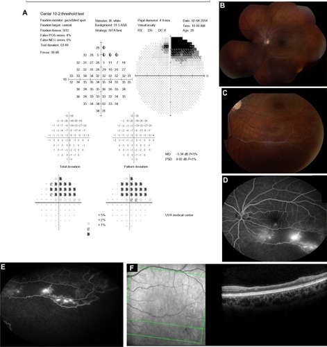 Figure 1 Visual field and fundus imaging of the patient with BRVO.