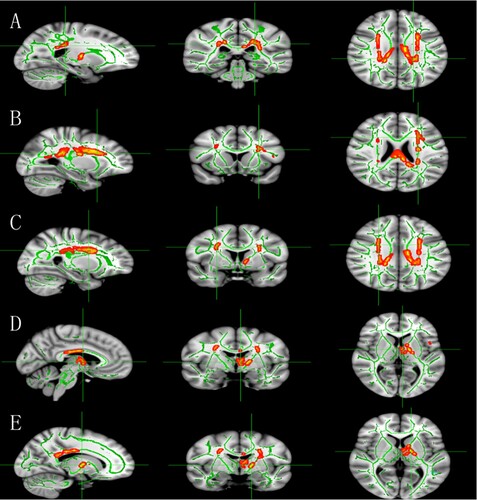 Figure 1. The white matter structures show significantly decreased fractional anisotropy (FA) in subjects with childhood maltreatment (CM) (p < .005 vs. non-CM, corrected for multiple comparisons). (A) Right posterior corona radiata (MNI x, y, z: 111, 93, 101), (B) right anterior corona radiata (MNI x, y, z: 117, 1141, 95), (C) left superior corona radiata (MNI x, y, z: 63, 129, 102), (D) anterior thalamic radiation (MNI x, y, z: 95, 122, 77), and (E) right posterior limb of internal capsule (MNI x, y, z: 105, 120, 76). Note: FA maps show sagittal, coronal, and axial views (from left to right). Green voxels represent the white matter skeleton of FA. Red–yellow voxels represent regions with significantly lower FA in subjects with CM relative to non-CM, thickened using the TBSS_fifill script implemented in FSL. FSL = Functional Magnetic Resonance Imaging of the Brain Software Library. TBSS = tract-based spatial statistics.