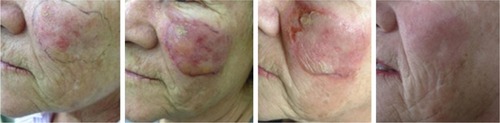 Figure 2 Clinical aspects at baseline, during and after ingenol mebutate treatment in a 71-year-old woman.