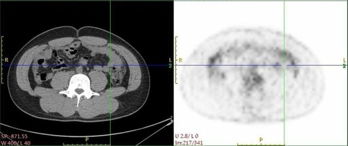 Figure 3 PET/CT images show abdomen area after the whole treatment (8 cycles).