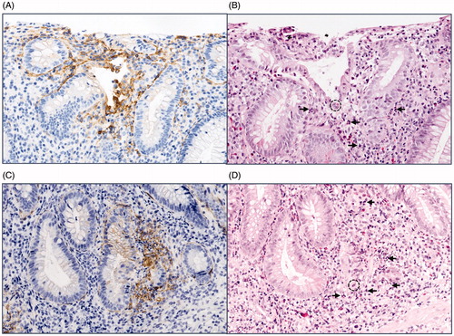 Figure 5. Stromal TF staining associated with acute intestinal inflammation. Comparative immunohistochemistry photos of adjacent colon sections showing (A, C) TF staining with positive stromal reaction (brown colour represents positive staining), and (B, D) haematoxylin-eosin staining, where neutrophil invasion can be seen in the corresponding epithelial area. Dotted circle exemplifies endothelial invasion (cryptitis), and the arrow exemplifies neutrophils. Original magnification 200×.