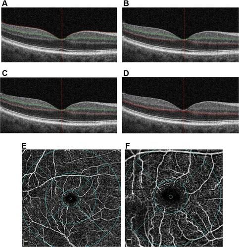 Figure 1 Optical coherence tomography (OCT) and OCT angiography (OCTA) images of the retinal vascular capillary plexus layers and macular zones on the ETDRS map. (A–C) Cross-sectional B-scan OCT images showing segmentation of the various retinal plexus layer including automated-segmentation of (A) the superficial capillary plexus (SCP; red and green lines outline the border) and (B) deep capillary plexus (DCP; red and green lines outline the border), (C) custom-segmented intermediate capillary plexus (cICP; red and green lines outline the border), and (D) custom-segmented deep capillary plexus (cDCP; two red lines outline the border). (E) An example of a 6x6 mm OCTA image of the DCP showing flow detected on an en face ETDRS map which includes the inner 1 mm circle (“fovea”), inner 3 mm ring and outer 6 mm ring. (F) An example of 3x3 mm OCTA image of the SCP showing flow detected on an enface ETDRS map of the macula, the inner 1 mm circle (ie, “fovea”) and inner 3 mm ring. (Overall ETDRS refers to the total 3 mm circle for the 3x3 mm scan and 6 mm circle for the 6x6 mm scan).