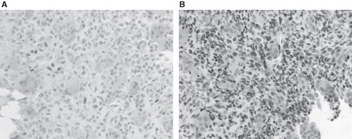 Figure 3. The p63 immunostaining of GCT involving the talus (A) and middle phalanx of the third digit (B). The tumor involving the talus was weakly positive for p63 and did not have any episode of recurrence for 4 years postoperatively, whereas that involving the middle phalanx was highly positive and two episodes of recurrence were noted within 4 years postoperatively.