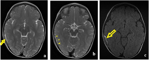 Figure 5 (a) The T2-WI axial section depicts a right temporoparietal lenticular collection (yellow arrow) with a small mass effect on the underlying brain parenchyma. (b) T2-WI axial section: yellow arrowheads point to the dura mater that appears as a fine black line between the hematoma and the brain parenchyma. (c) FLAIR axial imaging shows the same collection with a hyperintense signal (yellow arrow).