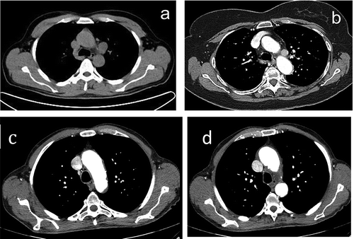 Figure 2. Lymph nodes in the aorto-pulmonary window: (a) enlarged and (b) positive to contrast CT scan, and (c and d) normal appearance.