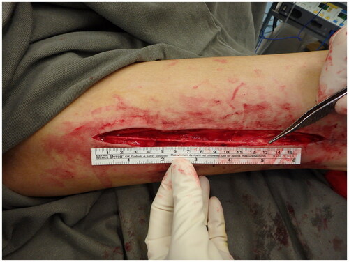 Figure 4. Saphenous vein graft was harvest from left medial thigh.