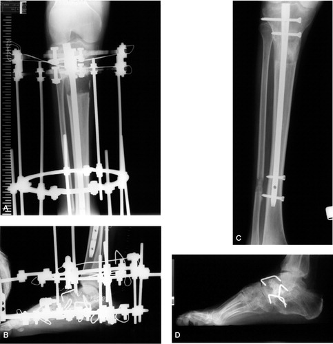 Figure 1 A. Lengthening over intramedullary nail. B. Triple arthrodesis with 3 staples and Ilizarov foot frame extended from the lengthening frame. C. After removal of external fixator. D. After removal of external fixator.