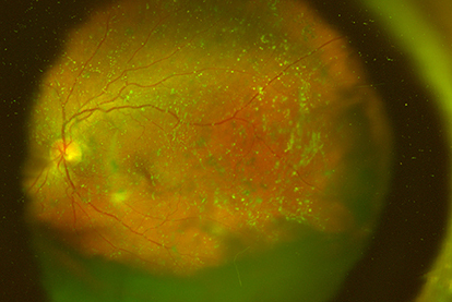 Figure 6 Ultra-wide view imaging of asteroid hyalosis.