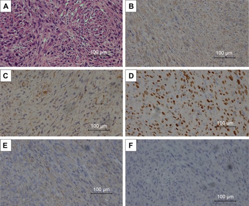 Figure 2 Histopathologic examination and immunohistochemistry staining of tumor cells.