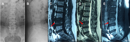 Figure 1 X-ray images showed a wedge-shaped change of the L4 vertebra (A and B). T1WI of MRI demonstrated hypointense signal (red arrow) and a clear horizontal fracture line of the L4 vertebra (C), T2WI showed mixed intensity signals (red arrow) of the L4 vertebra (D), and FS-T2WI showed hyperintense signal (red arrow) and clear horizontal fracture line of L4 vertebra, quasi-circular areas of high-intensity signal around L5 vertebra was due to MRI artifact (E).