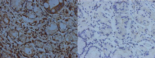 Figure 3. Immunohistochemistry results of VEGF.B1. Positive expression of VEGF in gastric cancer tissue. B2. Negative expression of VEGF in gastric cancer tissue.