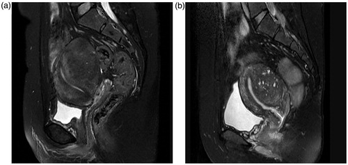 Figure 1. MRI images with and without hyperintensive points on T2WI. (a) No hyperintensive points (white dots) are present in this slice. (b) At least five hyperintensive points are shown on this slice.