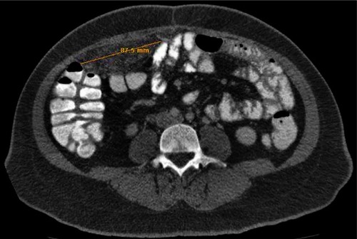 Figure 1 High resolution computed tomography showing a large mass in the right mesentery with stranding of fat within and surrounding it.