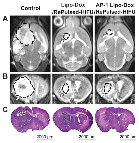 Figure 7 Twelve days after tumor implantation, three mice each from the control group, the untargeted liposomal doxorubicin with repeated sonication group, and the AP-1 liposomal doxorubicin with repeated sonication group were imaged by T2-weighted magnetic resonance imaging (A, coronal view; B, axial view), and then sacrificed for hematoxylin and eosin (C) histological examination (scale bar, 2000 μm).Abbreviations: AP-1, atherosclerotic plaque-specific peptide-1; Lipo-Dox, liposomal doxorubicin; HIFU, high-intensity focused ultrasound.