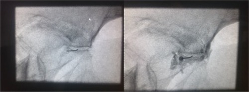 Figure 4 Intra-articular fluoroscopy-guided sacroiliac joint block.
