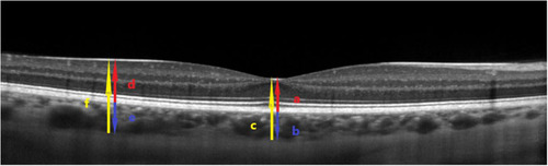 Figure 2 Representative OCT scan across the fovea. ILM and BM were detected automatically, while the choroidal-scleral junction was marked manually. SFCT was defined as the distance between the BM and the choroidal-scleral junction at the fovea (blue arrow b). The SFCT was obtained as a difference between the total thickness (retinal + choroidal thickness, from the ILM to the choroidal-scleral junction) (yellow arrow c) and the central foveal thickness (red arrow a). Analogically, the choroidal thickness outside the fovea (blue arrow e) was calculated by subtracting the retinal thickness (red arrow d) from the total thickness (retinal + choroidal thickness, from the ILM to the choroidal-scleral junction) (yellow arrow f).