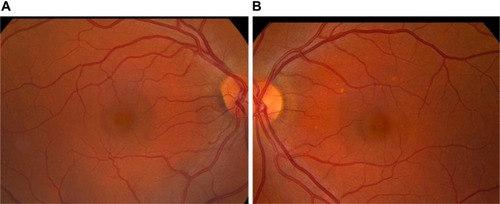 Figure 12 Retinal artery occlusion as a result of calcium hydroxylapatite in the central retinal artery.