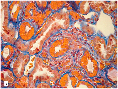 Figure 2. Orange, crystalloid deposits localized in the cytoplasm of PTEC (AFOG staining, original magnification 200×).