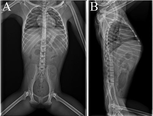 Figure 1. (A) ventrodorsal and (B) laterolateral x-rays of white-handed gibbon with Francisella tularensis subsp. holarctica infection show mild intestinal dilatation.