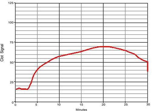 Figure 4 Example of hypocoagulopathy (ACT318, CR5.2, PF0.4). Clot signals climbed slowly and kept low during the testing time of 30 min.