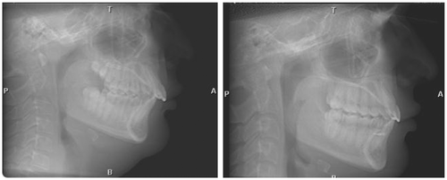 Figure 8 Airway improvement in a patient where lower incisors were advanced, spaces were created between lower bicuspid teeth, and posterior teeth were brought forward with TADS to close the spaces that had been created.