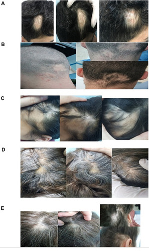 Figure 1 Clinical pictures of patients with various hair regrowth scale (RGS), (A) RGS 0 (<10%), (B) RGS 1 (11–25%), (C) RGS 2 (26–50%), (D) RGS 3 (51–75%), (E) RGS 4 (>75%).