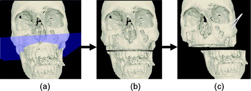 Figure 14. The use of the cut-plane tool and the independent manipulation of discontinuous bone regions. (a) The cut-plane tool is used to geometrically specify a set of voxels to remove. (b) The volume after voxel removal. (c) The flood-filling thread has recognized the discontinuity, and the bone segments can now be manipulated independently. [Color version available online.]