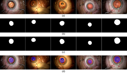 Figure 4 The anterior capsulotomy segmentation results of the UNet (DenseNet-169) model. (a) The video frames in various surgical phases of cataract surgery (the edge of capsulotomy is marked by green lines); (b) the manually annotated capsulotomy masks of (a); (c) the masks generated by the UNet (DenseNet-169 model); and (d) the overlay images of (a and c).