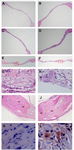 Figure 7 H&E staining and immunohistochemistry staining after 4 or 8 weeks postimplantation. (A) H&E staining of non-implant control after 4 weeks (×40); (B) H&E staining of non-implant control after 8 weeks (×40); (C) H&E staining of PLGA@ PEI group after 4 weeks (×40); (D) H&E staining of PLGA@PEI group after 8 weeks (×40); (E) H&E staining of PLGA@pBMP-2/PEI group after 4 weeks (×40), red arrow indicates new bone; (F) H&E staining of PLGA/pBMP-2/PEI group after 8 weeks (×40), red arrows indicate new bone; (G) Enlarged image of new bone area from Figure 6E. Red arrows indicate osteoblasts and yellow arrow indicates a macrophages phagocytized foreign materials; (H) Enlarged image of new bone area from Figure 6F. Red arrow indicates osteoblasts, and yellow arrow indicates a macrophages phagocytized foreign materials; (I) H&E staining of PLGA@pBMP-2/PEI group after 4 weeks (×200). OB: original bone (or lamellar bone); NB: new bone (or woven bone); Yellow arrow indicates the edge of the defect area; (J) H&E staining of PLGA@pBMP-2/PEI group after 8 weeks (×200). Yellow arrow indicates the edge of the defect area; (K) Human BMP-2 immunohistochemistry staining of PLGA@PEI group; (L) Human BMP-2 immunohistochemistry staining of PLGA/pBMP-2/PEI group.Abbreviations: H&E, hematoxylin and eosin stain; PLGA@PEI, poly(lactic-co-glycolic acid)@polyethlenimine; PLGA@pBMP-2/PEI, poly(lactic-co-glycolic acid)@plasmid of bone morphogenetic protein 2/polyethlenimine;
