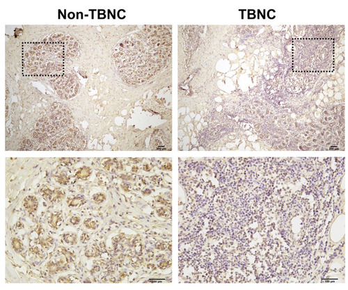 Figure 8 Immunohistochemistry analysis of LIFR protein in human TNBC tissues. Representative images of LIFR staining show that the expression of LIFR is lower in TNBC groups than in non-TNBC groups. Enlarged local images are also shown.