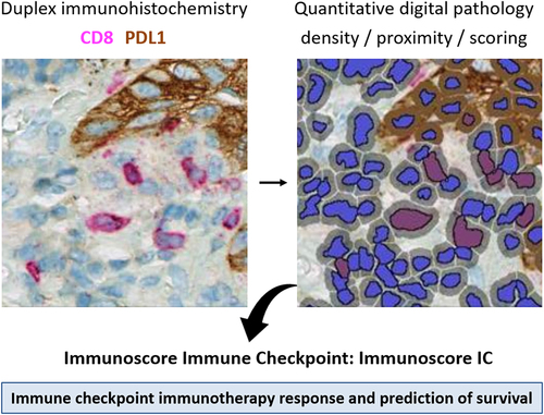 Figure 2. Immunoscore-IC assay. Duplex chromogenic immunohistochemistry on a single FFPE slide. Representative IHC staining of tumors with CD8 and PD-L1 antibodies, before (left) and after (right) digital pathology detection. Immunoscore-IC scores are generated using densities and proximities of CD8 and PD-L1 cells.