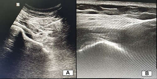 Figure 4 Sonography images collected from our series of patients; (A) image obtained during vasco-supplementation of the Hip using the convex probe, with obvious thickening of the joint capsule and small quantity of intra articular fluid; (B) image obtained from a patient suffering from Milwaukee Shoulder arthropathy were evacuation was attempted (with no success due to high viscosity of intra articular deposits) before local steroid injection.