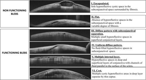 Figure 1 Overview of the bleb morphology classification system.