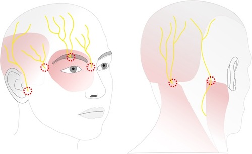 Figure 1 Sensory innervation of the skull and injection sites.