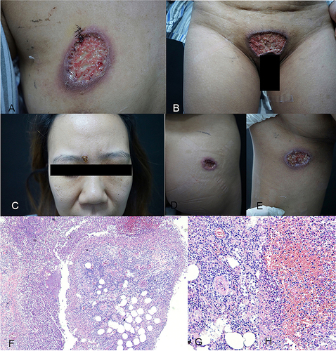 Figure 1 Clinical manifestations in a 38-year-old female with PG before treatment. Scattered ulcers were seen on the patient’s pubic area, left thigh, right buttock, right breast, and eyebrow, with red granulation tissue and yellow necrotic debris on the surface of the ulcers and edema at the elevated border. (A–E) Histopathology of a PG lesion from the right thorax (stained with haematoxylin and eosin; magnifications: (F) ×40, ((G and H) ×200). The epidermis is hypertrophic, spongy and oedematous, with neutrophil migration into the epidermis (F). The dermis is locally infiltrated with neutrophils forming areas of cerebral swelling and necrosis, with surrounding areas of granulomatous inflammation and infiltration of inflammatory cells such as lymphocytes, plasma cells and eosinophils (G), with necrosis of the vessel wall and spillage of large red blood cells (H).