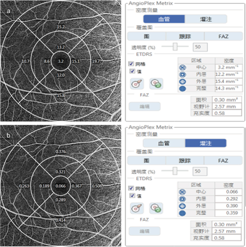 Figure 1. Optical coherence tomography angiography 6×6mm scan image centered on the optic disc. The diameters of the three concentric circles are 1, 3, and 6mm. The measurement tool (AngioPlex software, version 10.0; Carl Zeiss Meditec) provided (a) vessel density and (b) perfusion density measurements in individual subfields. The bold box shows the automatic quantitative measurements for an average of the inner ring, outer ring, and full area.