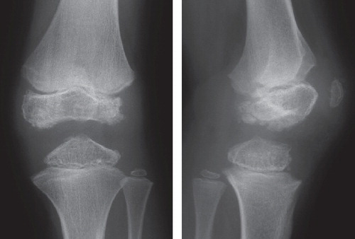 Figure 2.  Subject IV:10. Left knee at age 12. The figure shows typical findings with irregular ossification of the epiphyses and delayed ossification of the patella.