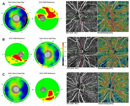 Figure 1 RNFL, GCC thickness map and RPC VD in three eyes with unilateral preperimetric glaucoma. (A) Abnormal (red coded) thinning of superior temporal RNFL and superior GCC corresponded with a peripapillary area of decreased VD (41%). The inferior temporal sector showed dense VD (64%). (B) RNFL thickness map was borderline (yellow coded) inferotemporally. In GCC map a statistically abnormal (red coded) inferior focal thinning was detected which corresponded with a peripapillary area of decreased VD (38%). The superior temporal sector showed normal VD (52%). (C) A case of “green disease” in RNFL thickness map. Inferior temporal RNFL thickness was statistically within normal limits (green coded), though there was a difference of 13 μm between superior temporal (123 μm) and inferior temporal (110 μm) sectors. In GCC map a statistically significant red coded inferior focal thinning was detected which corresponded with a peripapillary area of decreased VD (43%). The superior temporal sector showed normal VD (55%).Abbreviations: RNFL, retinal nerve fiber layer; GCC, ganglion cell complex; NDB, normative database; RPC, radial peripapillary capillaries; VD, vessel density.